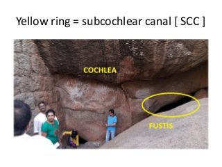Yellow ring = subcochlear canal [ SCC ]
 