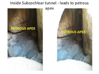 Inside Subcochlear tunnel - leads to petrous
apex
 