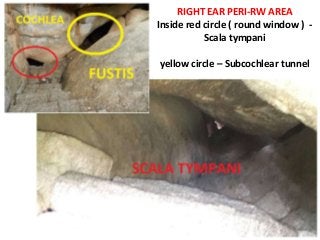 RIGHT EAR PERI-RW AREA
Inside red circle ( round window ) -
Scala tympani
yellow circle – Subcochlear tunnel
 