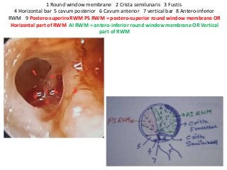 1 Round window membrane 2 Crista semilunaris 3 Fustis
4 Horizontal bar 5 cavum posterior 6 Cavum anterior 7 vertical bar 8 Antero-inferior
RWM 9 Postero-superiro RWM PS RWM = postero-superior round window membrane OR
Horizontal part of RWM AI RWM = antero-inferior round window membrane OR Vertical
part of RWM
 