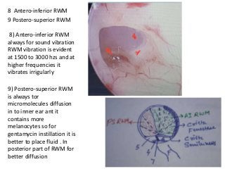 8 Antero-inferior RWM
9 Postero-superior RWM
8) Antero-inferior RWM
always for sound vibration
RWM vibration is evident
at 1500 to 3000 hzs and at
higher frequencies it
vibrates irrigularly
9) Postero-superior RWM
is always tor
micromolecules diffusion
in to inner ear ant it
contains more
melanocytes so for
gentamycin instillation it is
better to place fluid . In
posterior part of RWM for
better diffusion
 