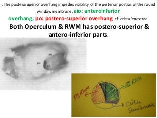 . The posterosuperior overhang impedes visibility of the posterior portion of the round
window membrane, aio: anteroinferior
overhang; po: postero-superior overhang; cf: crista fenestrae.
Both Operculum & RWM has postero-superior &
antero-inferior parts.
 