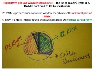 Right RWM [ Round Window Membrane ] - the junction of PS RWM & AI
RWM is anchored to Crista semilunaris
PS RWM = postero-superior round window membrane OR Horizontal part of
RWM
AI RWM = antero-inferior round window membrane OR Vertical part of RWM
 