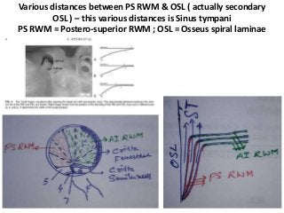 Various distances between PS RWM & OSL ( actually secondary
OSL ) – this various distances is Sinus tympani
PS RWM = Postero-superior RWM ; OSL = Osseus spiral laminae
 