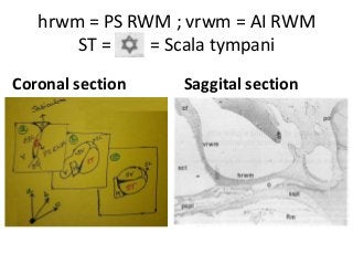 hrwm = PS RWM ; vrwm = AI RWM
ST = = Scala tympani
Coronal section Saggital section
 