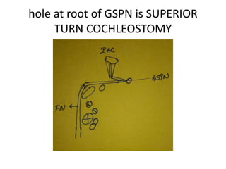 If we drill between OW & RW it is
SCALA VESTIBULAR COCHLEOSTOMY
 