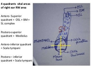 4 quadrants vital areas
of right ear RW area
Antero- Superior
quadrant = OSL + BM +
SL complex
Postero-superior
quadrant = Modiolus
Antero-inferior quadrant
= Scala tympani
Postero – inferior
quadrant = Scala tympani
 