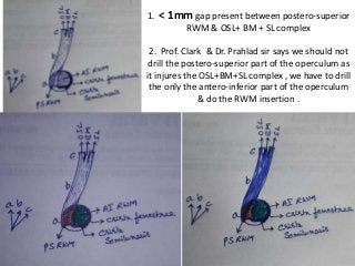 1. < 1mm gap present between postero-superior
RWM & OSL+ BM + SL complex
2. Prof. Clark & Dr. Prahlad sir says we should not
drill the postero-superior part of the operculum as
it injures the OSL+BM+SL complex , we have to drill
the only the antero-inferior part of the operculum
& do the RWM insertion .
 