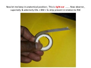 Now let me keep in anatomical position ; This is right ear ……. Now observe ,
superiorly & anteriorly OSL + BM + SL strip present in relation to RW
 
