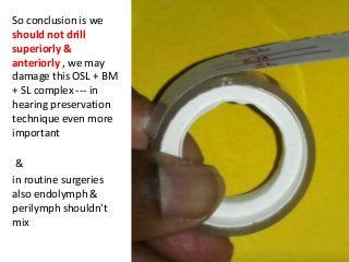So conclusion is we
should not drill
superiorly &
anteriorly , we may
damage this OSL + BM
+ SL complex --- in
hearing preservation
technique even more
important
&
in routine surgeries
also endolymph &
perilymph shouldn't
mix
 