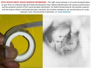 BOTH PHOTOS RIGHT ROUND WINDOW MEMBRANES - The right round window in a human temporal bone
as seen from an endaural approach demonstrating the close relationship between the osseous spiral lamina
and the posterior portion of the round window membrane. For better demonstration the postero-superior
and the antero-inferior overhang have been removed, bm: basiliar membrane; spl: spiral lamina; set: scala
tympani; rwm: found window membrane, cf: crista fenestrae
 