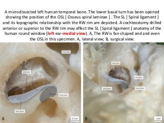 A microdissected left human temporal bone. The lower basal turn has been opened
showing the position of the OSL [ Osseus spiral laminae ] . The SL [ Spiral ligament ]
and its topographic relationship with the RW rim are depicted. A cochleostomy drilled
anterior or superior to the RW rim may affect the SL [ Spiral ligament ] anatomy of the
human round window (left ear-medial view). A, The RW is fan shaped and and even
the OSL in this specimen. A, lateral view; B, surgical view.
 
