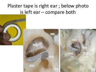 Plaster tape is right ear ; below photo
is left ear – compare both
 