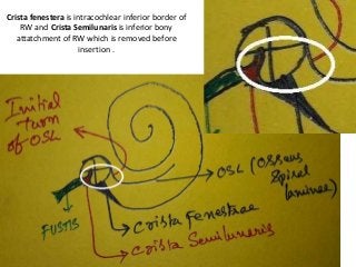 Crista fenestera is intracochlear inferior border of
RW and Crista Semilunaris is inferior bony
attatchment of RW which is removed before
insertion .
 