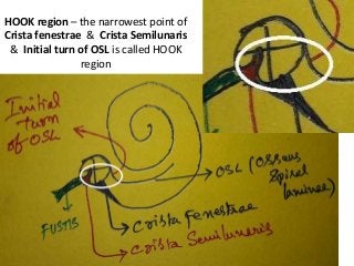 HOOK region – the narrowest point of
Crista fenestrae & Crista Semilunaris
& Initial turn of OSL is called HOOK
region
 