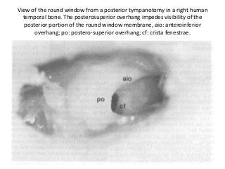 View of the round window from a posterior tympanotomy in a right human
temporal bone. The posterosuperior overhang impedes visibility of the
posterior portion of the round window membrane, aio: anteroinferior
overhang; po: postero-superior overhang; cf: crista fenestrae.
 