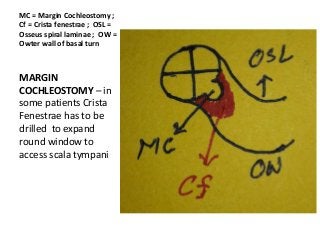 MC = Margin Cochleostomy ;
Cf = Crista fenestrae ; OSL =
Osseus spiral laminae ; OW =
Owter wall of basal turn
MARGIN
COCHLEOSTOMY – in
some patients Crista
Fenestrae has to be
drilled to expand
round window to
access scala tympani
 