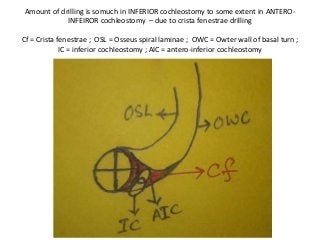 Amount of drilling is somuch in INFERIOR cochleostomy to some extent in ANTERO-
INFEIROR cochleostomy – due to crista fenestrae drilling
Cf = Crista fenestrae ; OSL = Osseus spiral laminae ; OWC = Owter wall of basal turn ;
IC = inferior cochleostomy ; AIC = antero-inferior cochleostomy
 
