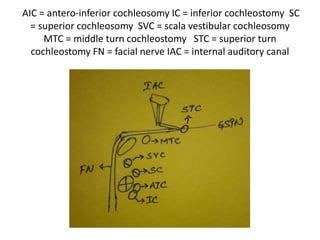 Relation of middle
turn cochleostomy
in relation to
dangerous triangle
– explained
further indetail
 