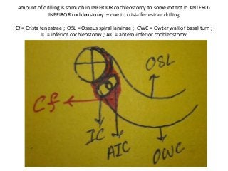 Amount of drilling is somuch in INFERIOR cochleostomy to some extent in ANTERO-
INFEIROR cochleostomy – due to crista fenestrae drilling
Cf = Crista fenestrae ; OSL = Osseus spiral laminae ; OWC = Owter wall of basal turn ;
IC = inferior cochleostomy ; AIC = antero-inferior cochleostomy
 