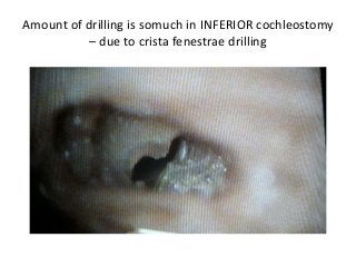 Amount of drilling is somuch in INFERIOR cochleostomy
– due to crista fenestrae drilling
 