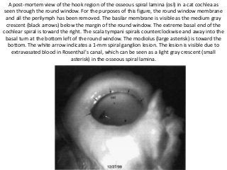 A post-mortem view of the hook region of the osseous spiral lamina (osl) in a cat cochlea as
seen through the round window. For the purposes of this figure, the round window membrane
and all the perilymph has been removed. The basilar membrane is visible as the medium gray
crescent (black arrows) below the margin of the round window. The extreme basal end of the
cochlear spiral is toward the right. The scala tympani spirals counterclockwise and away into the
basal turn at the bottom left of the round window. The modiolus (large asterisk) is toward the
bottom. The white arrow indicates a 1-mm spiral ganglion lesion. The lesion is visible due to
extravasated blood in Rosenthal's canal, which can be seen as a light gray crescent (small
asterisk) in the osseous spiral lamina.
 