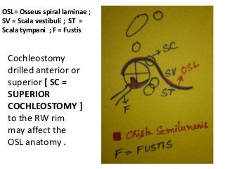 OSL= Osseus spiral laminae ;
SV = Scala vestibuli ; ST =
Scala tympani ; F = Fustis
Cochleostomy
drilled anterior or
superior [ SC =
SUPERIOR
COCHLEOSTOMY ]
to the RW rim
may affect the
OSL anatomy .
 