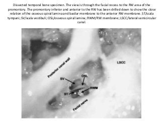 Dissected temporal bone specimen. The view is through the facial recess to the RW area of the
promontory. The promontory inferior and anterior to the RW has been drilled down to show the close
relation of the osseous spiral lamina and basilar membrane to the anterior RW membrane. ST/scala
tympani; SV/scala vestibuli; OSL/osseous spiral lamina; RWM/RW membrane; LSCC/lateral semicircular
canal.
 