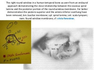 The right round window in a human temporal bone as seen from an endaural
approach demonstrating the close relationship between the osseous spiral
lamina and the posterior portion of the round window membrane. For better
demonstration the postero-superior and the antero-inferior overhang have
been removed, bm: basiliar membrane; spl: spiral lamina; set: scala tympani;
rwm: found window membrane, cf: crista fenestrae.
 