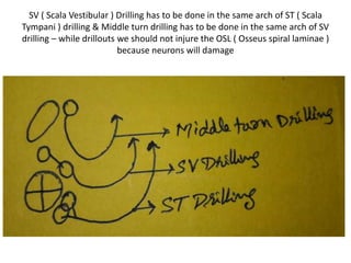 Osseus spiral laminae is seen through SUPERIOR COCHLEOSTOMY . The space
above osseus spiral laminae is SCALA VESTIBULI & space below osseus spiral
laminae is SCALA TYMPANI
 