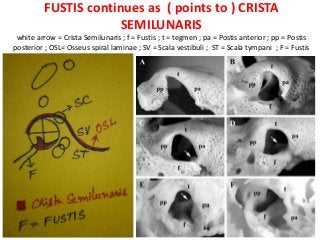 FUSTIS continues as ( points to ) CRISTA
SEMILUNARIS
white arrow = Crista Semilunaris ; f = Fustis ; t = tegmen ; pa = Postis anterior ; pp = Postis
posterior ; OSL= Osseus spiral laminae ; SV = Scala vestibuli ; ST = Scala tympani ; F = Fustis
 