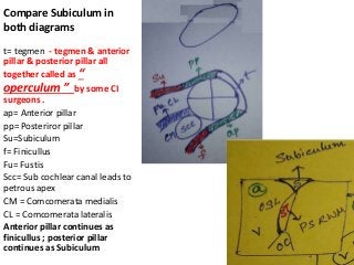 Compare Subiculum in
both diagrams
t= tegmen - tegmen & anterior
pillar & posterior pillar all
together called as “
operculum ” by some CI
surgeons .
ap= Anterior pillar
pp= Posteriror pillar
Su=Subiculum
f= Finicullus
Fu= Fustis
Scc= Sub cochlear canal leads to
petrous apex
CM = Comcomerata medialis
CL = Comcomerata lateralis
Anterior pillar continues as
finicullus ; posterior pillar
continues as Subiculum
 
