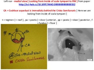 Left ear - medial view [ Looking from inside of scala tympani to RW ] from paper
http://sci-hub.cc/10.1097/MAO.0000000000000332
CA = Cochlear aqueduct is immedialy behind the Crista Semilunaris [ Here we are
looking from inside of scala tympani ]
t = tegmen [ = roof ] , pa = postis [ = door ] anterior , pp = postis [ = door ] posterior , f
= fundus [ = floor ]
 