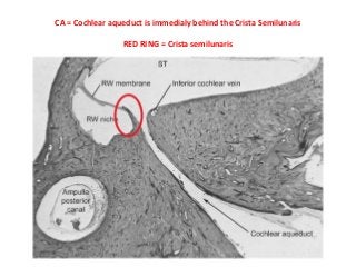 CA = Cochlear aqueduct is immedialy behind the Crista Semilunaris
RED RING = Crista semilunaris
 
