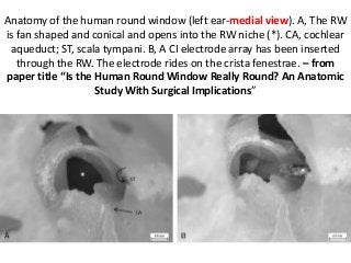 Anatomy of the human round window (left ear-medial view). A, The RW
is fan shaped and conical and opens into the RW niche (*). CA, cochlear
aqueduct; ST, scala tympani. B, A CI electrode array has been inserted
through the RW. The electrode rides on the crista fenestrae. – from
paper title “Is the Human Round Window Really Round? An Anatomic
Study With Surgical Implications”
 
