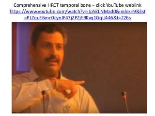 Comprehensive HRCT temporal bone – click YouTube weblink
https://www.youtube.com/watch?v=iJp9ZLNMad0&index=9&list
=PLZquE6mn0cynJF47j2PZjEBKvq1GqU446&t=226s
 