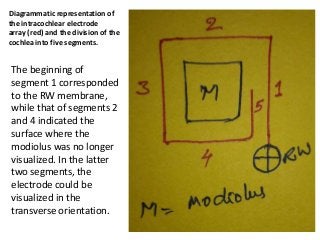 Diagrammatic representation of
the intracochlear electrode
array (red) and the division of the
cochlea into five segments.
The beginning of
segment 1 corresponded
to the RW membrane,
while that of segments 2
and 4 indicated the
surface where the
modiolus was no longer
visualized. In the latter
two segments, the
electrode could be
visualized in the
transverse orientation.
 