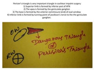 Osseus spiral laminae is seen through SCALA VESTIBULAR
COCHLEOSTOMY with angulation of microscope
 
