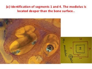(a) Identification of segments 1 and 4. The modiolus is
located deeper than the bone surface..
 