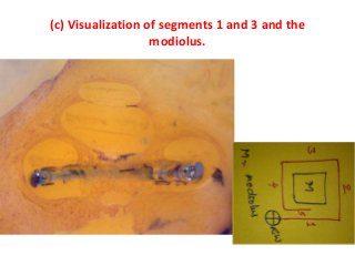 (c) Visualization of segments 1 and 3 and the
modiolus.
 