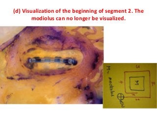 (d) Visualization of the beginning of segment 2. The
modiolus can no longer be visualized.
 