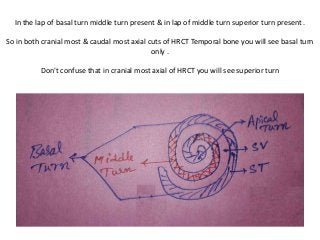 In the lap of basal turn middle turn present & in lap of middle turn superior turn present .
So in both cranial most & caudal most axial cuts of HRCT Temporal bone you will see basal turn
only .
Don't confuse that in cranial most axial of HRCT you will see superior turn
 