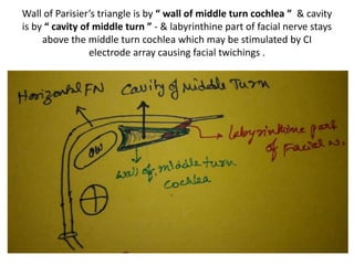 hole at root of GSPN is SUPERIOR
TURN COCHLEOSTOMY
 