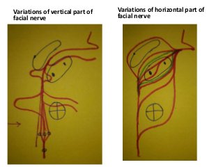 Variations of vertical part of
facial nerve
Variations of horizontal part of
facial nerve
 