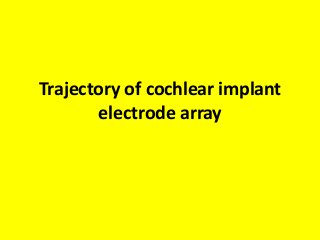 Trajectory of cochlear implant
electrode array
 