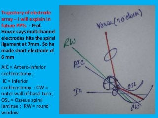 Trajectory of electrode
array – I will explain in
future PPTs - Prof.
House says multichannel
electrodes hits the spiral
ligament at 7mm . So he
made short electrode of
6 mm
AIC = Antero-inferior
cochleostomy ;
IC = Inferior
cochleostomy ; OW =
outer wall of basal turn ;
OSL = Osseus spiral
laminae ; RW = round
window
 