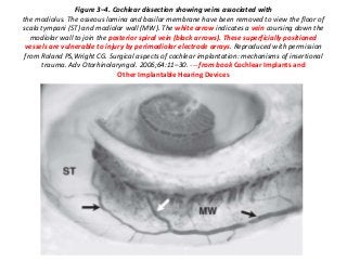 Figure 3–4. Cochlear dissection showing veins associated with
the modiolus. The osseous lamina and basilar membrane have been removed to view the floor of
scala tympani (ST) and modiolar wall (MW). The white arrow indicates a vein coursing down the
modiolar wall to join the posterior spiral vein (black arrows). These superficially positioned
vessels are vulnerable to injury by perimodiolar electrode arrays. Reproduced with permission
from Roland PS,Wright CG. Surgical aspects of cochlear implantation: mechanisms of insertional
trauma. Adv Otorhinolaryngol. 2006;64:11–30. --- from book Cochlear Implants and
Other Implantable Hearing Devices
 