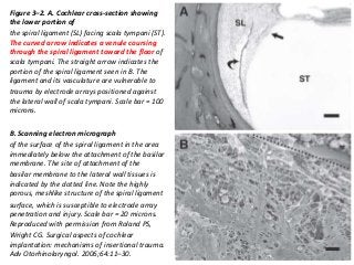 Figure 3–2. A. Cochlear cross-section showing
the lower portion of
the spiral ligament (SL) facing scala tympani (ST).
The curved arrow indicates a venule coursing
through the spiral ligament toward the floor of
scala tympani. The straight arrow indicates the
portion of the spiral ligament seen in B. The
ligament and its vasculature are vulnerable to
trauma by electrode arrays positioned against
the lateral wall of scala tympani. Scale bar = 100
microns.
B. Scanning electron micrograph
of the surface of the spiral ligament in the area
immediately below the attachment of the basilar
membrane. The site of attachment of the
basilar membrane to the lateral wall tissues is
indicated by the dotted line. Note the highly
porous, meshlike structure of the spiral ligament
surface, which is susceptible to electrode array
penetration and injury. Scale bar = 20 microns.
Reproduced with permission from Roland PS,
Wright CG. Surgical aspects of cochlear
implantation: mechanisms of insertional trauma.
Adv Otorhinolaryngol. 2006;64:11–30.
 