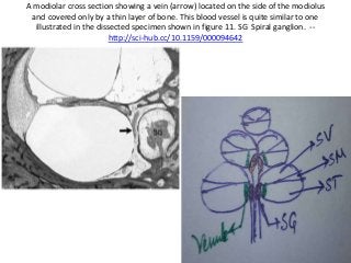 A modiolar cross section showing a vein (arrow) located on the side of the modiolus
and covered only by a thin layer of bone. This blood vessel is quite similar to one
illustrated in the dissected specimen shown in figure 11. SG Spiral ganglion. --
http://sci-hub.cc/10.1159/000094642
 
