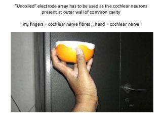 “Uncoiled” electrode array has to be used as the cochlear neurons
present at outer wall of common cavity
my fingers = cochlear nerve fibres ; hand = cochlear nerve
 